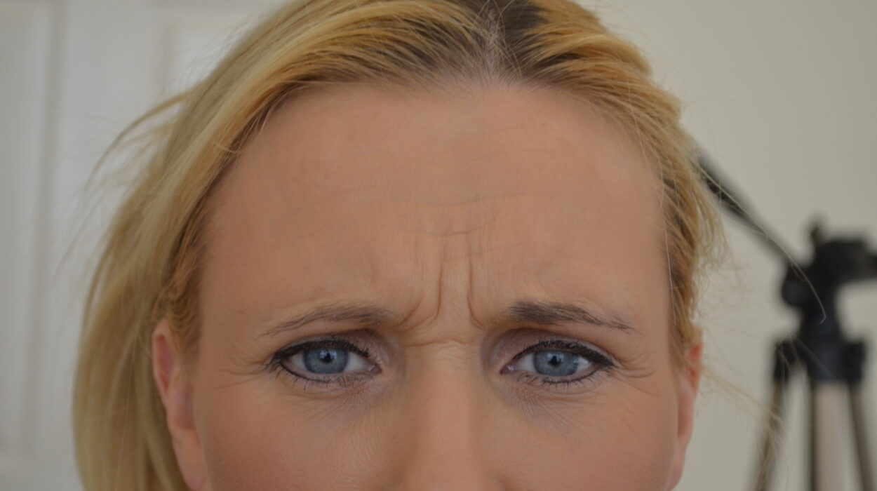 Part 1 – Anti Wrinkle Injections Before