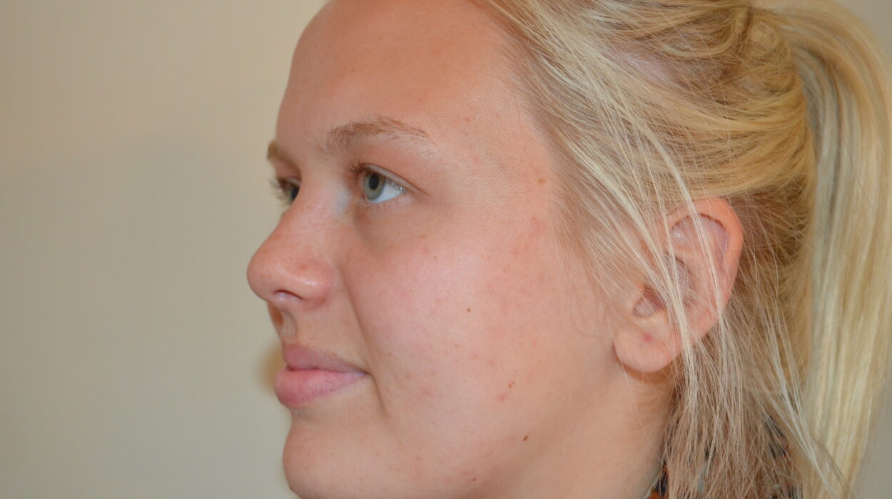 Active Acne After