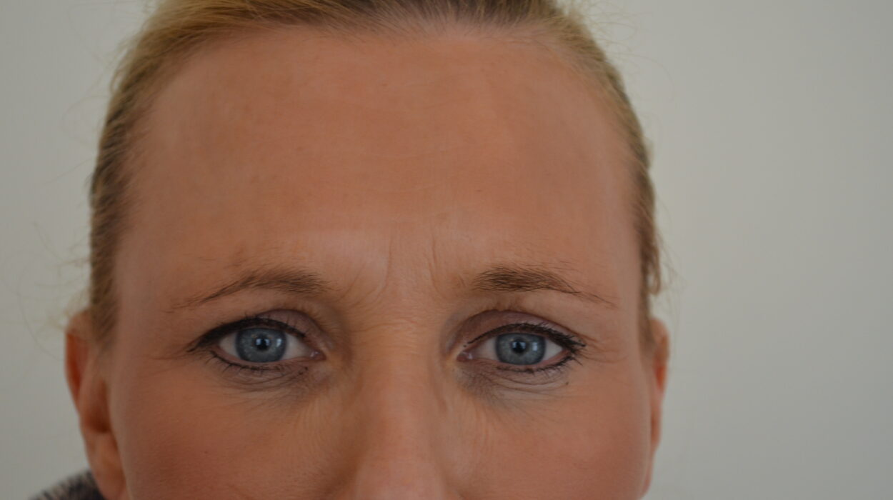 Part 1 – Anti Wrinkle Injections After