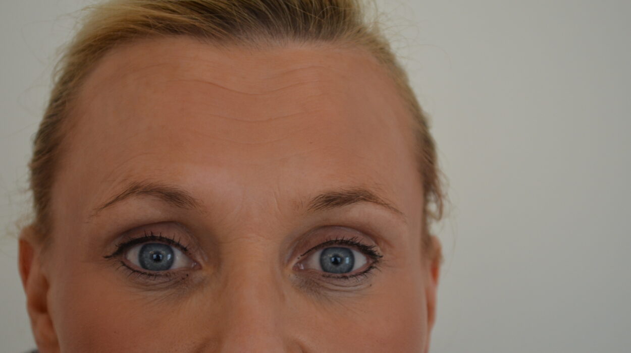 Anti Wrinkle Injections After