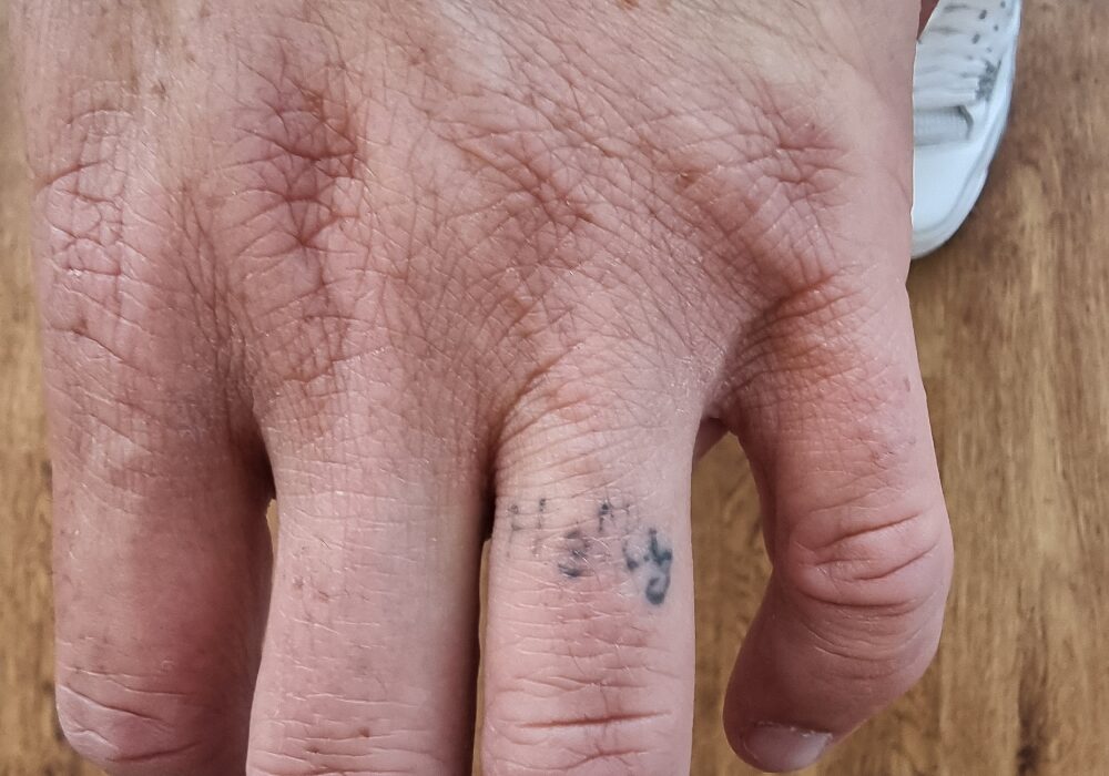 Laser tattoo removal Before
