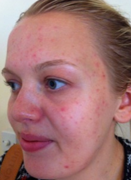 Active Acne Before