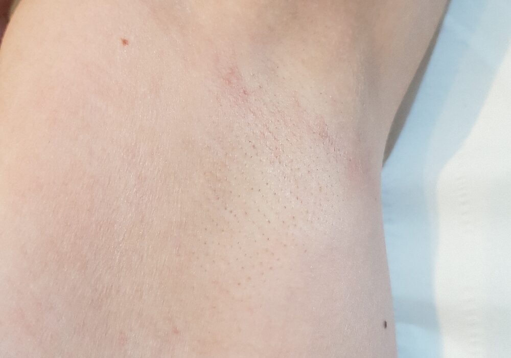 Laser hair removal After