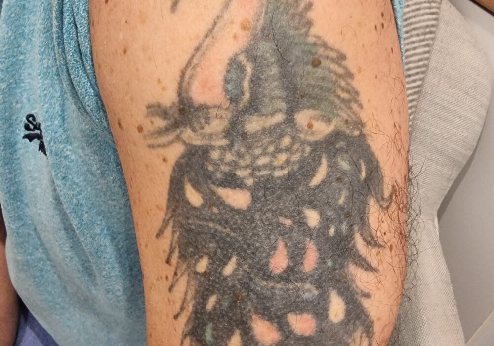Laser tattoo removal Before
