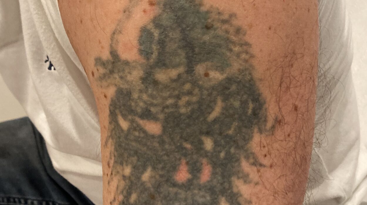 Laser tattoo removal During