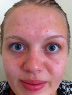 Active Acne Before