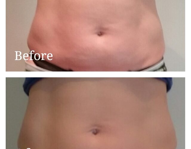 Skin Tightening And Cellulite Reduction £55