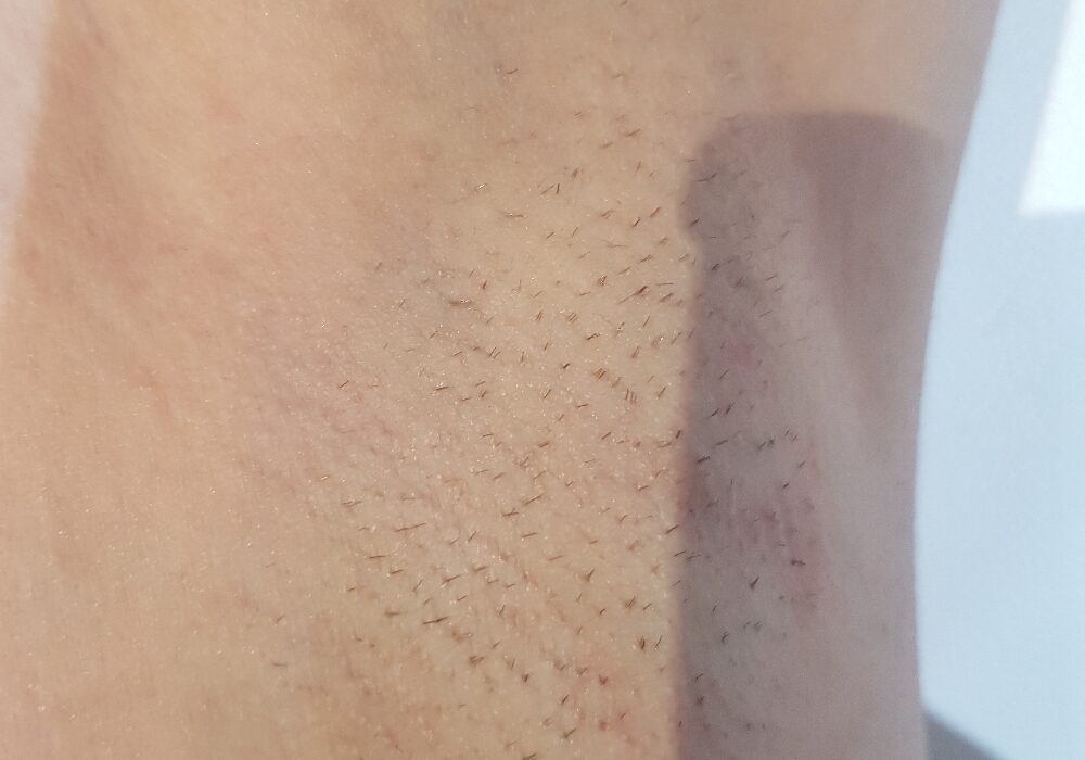 Laser hair removal Before