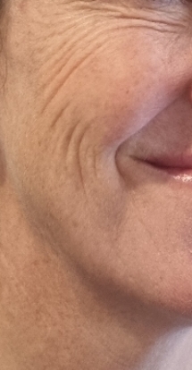 Cheek Wrinkles Before